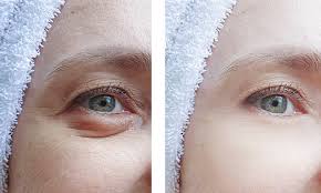 how long does blepharoplasty last