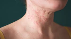 eczema on the face and neck triggers