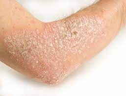 natural cures for skin rash
