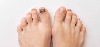 black toenails premier podiatry