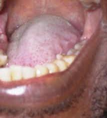 treatment of candidiasis