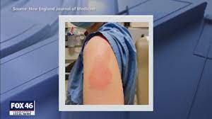 What is 'moderna arm?' i received the first dose of the moderna vaccine without any significant event. Moderna Arm Some Report Itchy Rash After Getting Moderna Vaccine Wbtw
