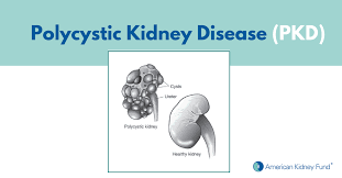 Polycystic Kidney Disease Pkd Symptoms Treatments