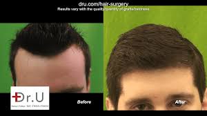 hair transplant with dr ugraft fue