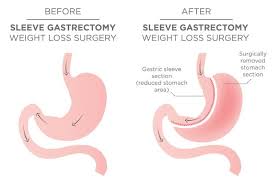 gastric sleeve revision ohio vsg