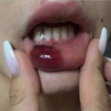 lips diagnose manage avoid