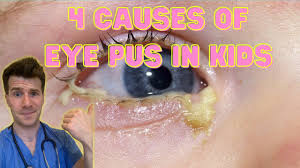 eye pus discharge or sticky eyes