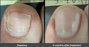 laser treatment for toenail fungus