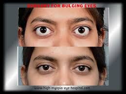 bulging eye treatments at best in