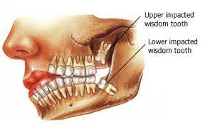 I was expecting them to be painful when they started coming through, but only found vinod patel, consultant oral surgeon at guy's and st thomas' hospital in london, says this means that the majority of us have impacted wisdom teeth. What Happens If You Don T Take Out Your Wisdom Teeth Austin Aos