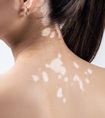 white spots on skin causes and how to