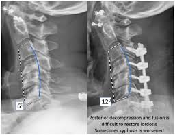 lordosis and spine surgery like two