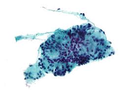 Fine needle aspiration cytology is considered the gold standard diagnostic test for the diagnosis of thyroid nodules. Fine Needle Aspiration Wikipedia