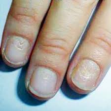 what do nail problems mean for your health