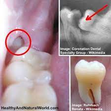 My wisdom teeth are killing me, what can i do until i find a dentist? Pin On Dental Related