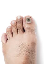 Are oral medications for nail fungus toxic? Can You Get Black Toenail Fungus