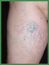 The most ,important ,causes , of, varicose veins