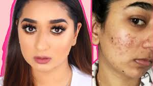 hindi video how to cover acne scars