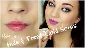 how to treat hide cold sores