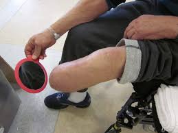 Image result for prosthetic leg hygiene