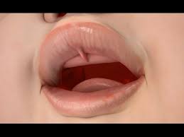 upper lip tie release treatment you