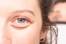 what causes bags under eyes how to get