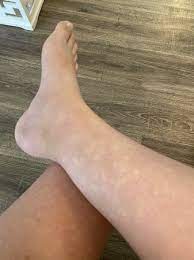 white spots on legs 33 weeks babycenter