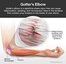 golfer s elbow
