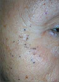 black spots on both sides of face