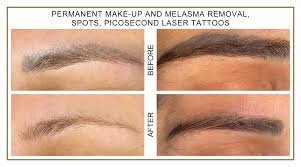 permanent make up and melasma removal