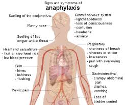 Anaphylaxis Wikipedia