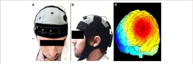 An Illustration Of The Tdcs Montage In This Study Starstim