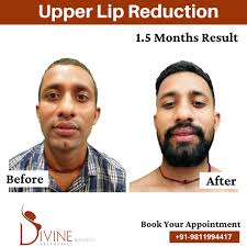 lip surgery before and after results