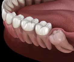 wisdom teeth dental clinic puchong