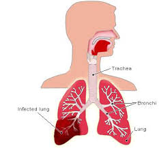 Hasil gambar untuk pneumonia aspirasi anak pdf