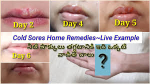 cold sores home remes in telugu