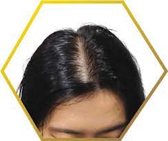 female pattern baldness hair loss