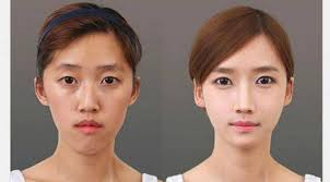 orang korea setelah operasi plastik