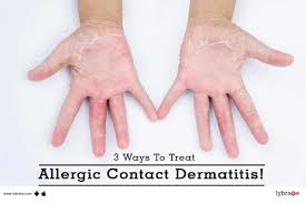 treat allergic contact dermais