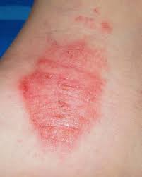 identifying 21 common red spots on skin