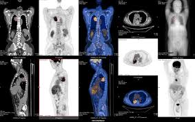 Pet scan images can detect cellular changes in organs and tissues earlier than ct and mri scans. Pet Ct Scan Hk Price Pet Scan Cost In Hong Kong