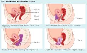 Female Pelvic Floor 1 Anatomy And Pathophysiology Nursing