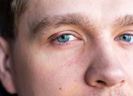 what you need to know about styes are