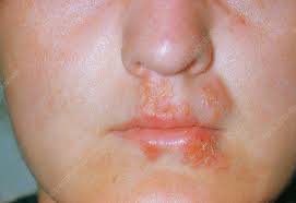 herpes simplex sores on lip mouth
