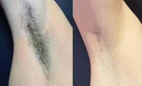 Call today for a free consult! Dr Rick Jaggi Laser Hair Removal