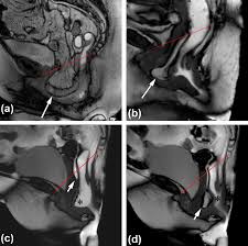 dynamic pelvic floor mri