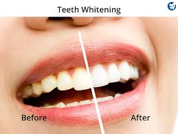 affordable teeth whitening abroad