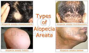 what is alopecia areata various types