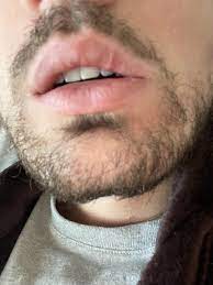 split lip scar raised lip scar photos
