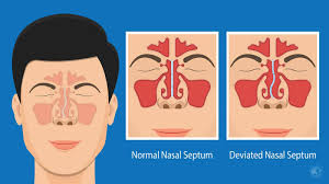 8 signs of a deviated septum never to